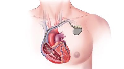 Tiga Kabel Penyinkron Jantung