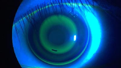 Penggunaan lensa ortho-k pada mata seorang penderita miopia. shutterstock