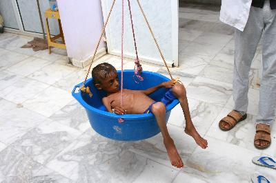 Anak laki-laki kekurang gizi mendapat perawatan di rumah sakit di distrik Aslam, Provinsi Hajjah, Yaman, 18 Juli 2020. REUTERS/Eissa Alragehi 