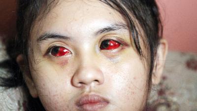 Cahayu Nur Dewata menunjukkan matanya yang masih memerah akibat menjadi salah satu korban luka di Tragedi Kanjuruhan di Kedungkandang, Malang, Jawa Timur, 12 Oktober 2022.  ANTARA/Ari Bowo Sucipto