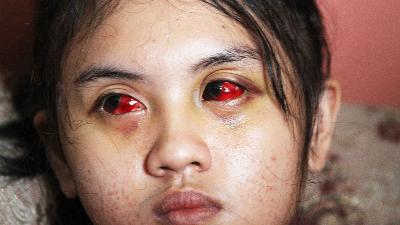 Arema FC supporter Cahayu Nur Dewata shows her red eyes cause by exposure to tear gas during the Kanjuruhan Tragedy in Kedungkandang, Malang, East Java, October 12.
ANTARA FOTO/Ari Bowo Sucipto

