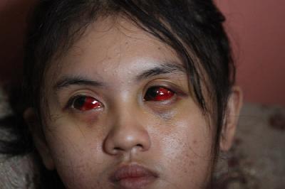 Suporter Arema FC (Aremania) Cahayu Nur Dewata menunjukkan matanya yang masih memerah akibat menjadi salah satu korban luka di Tragedi Kanjuruhan di Kedungkandang, Malang, Jawa Timur, 12 Oktober 2022. ANTARA/Ari Bowo Sucipto