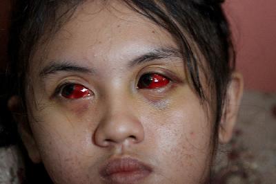 Suporter Arema FC Cahayu Nur Dewata menunjukkan matanya yang masih merah akibat gas air mata, di Kedungkandang, Malang, Jawa Timur,12 Oktober 2022. ANTARA/Ari Bowo Sucipto
