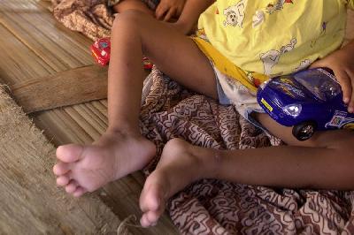 Ilustrasi anak penderita polio. Dok. TEMPO/ Arie Basuki
