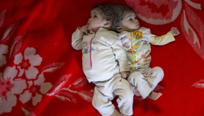 Bayi kembar siam bernama Mai dan Menna di kediamannya Sadat, Mesir, 22 April 2016. Bayi perempuan kembar yang menempel pada bagian kepala belakang ini, keadaannya kian hari kian memburuk. AP Photo/Amr Nabil